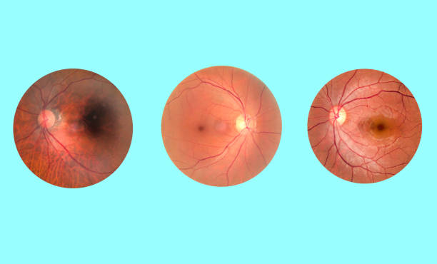 Comparación de fondos de ojo mostrando distintos estados de la mácula